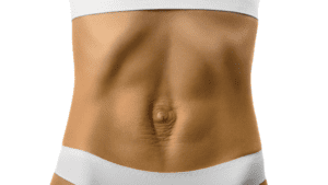 diastaza abdominala